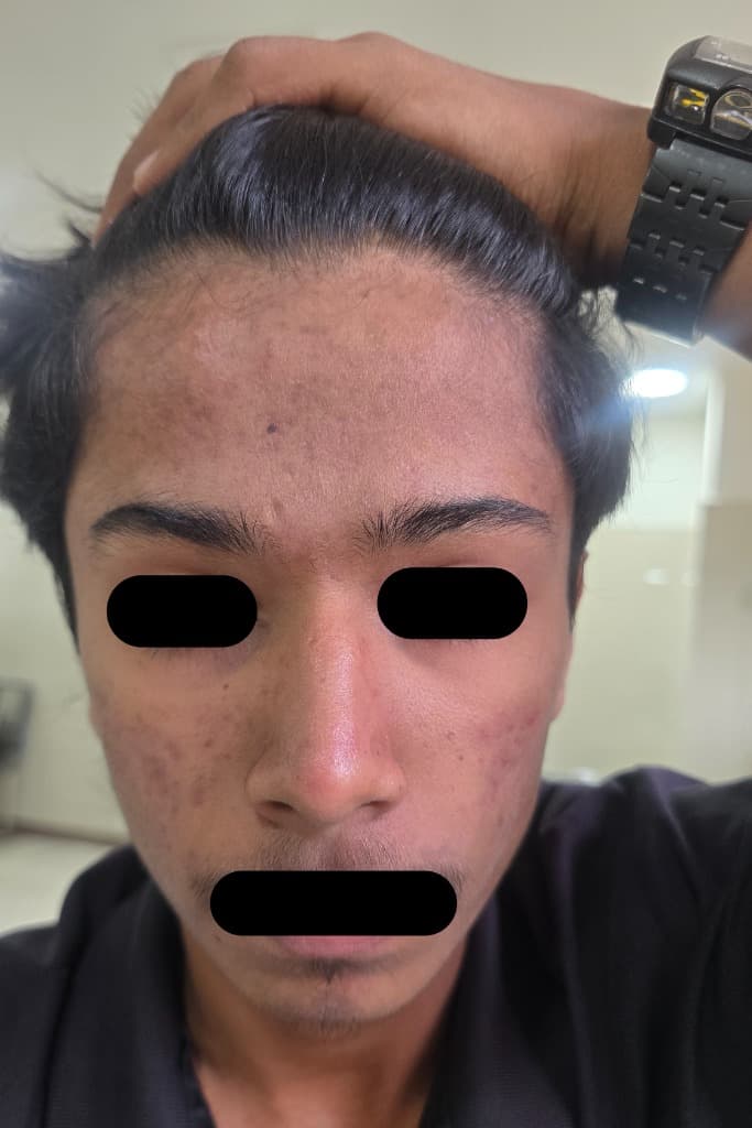 After - Severe Acne & Scarring Case Study