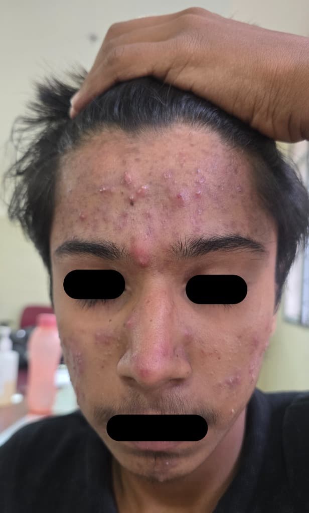 Before - Severe Acne & Scarring Case Study