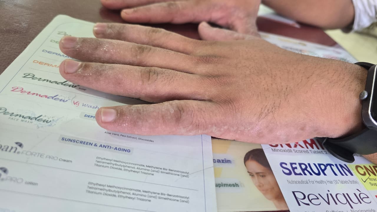 Before - Hyperhidrosis Treatment Case Study